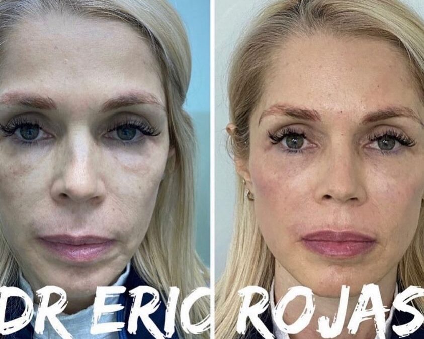 Rejuvenecimiento facial