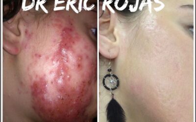 ACNÉ SEVERO BUSCANOS DR ÉRIC ROJAS
