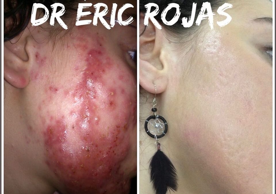 ACNÉ SEVERO BUSCANOS DR ÉRIC ROJAS