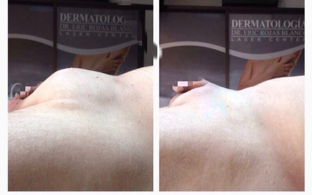 El pubis en el hombre también lo podemos disminuir