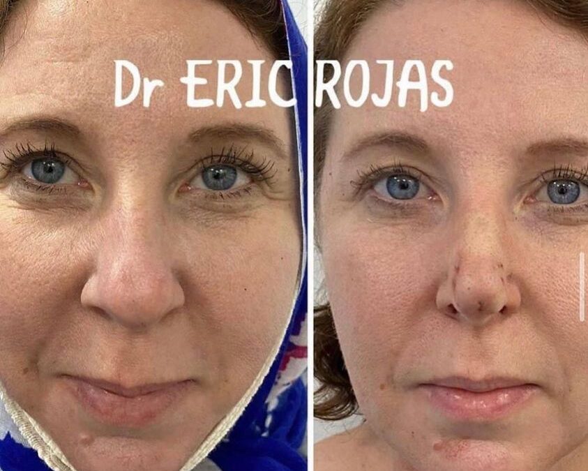 Afinamiento de punta de nariz