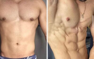 Marcaje de abdomen