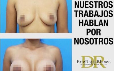 Aumento de mamás