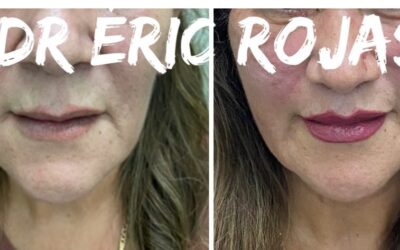 Acotamiento de labio superior para rejuvenecer su rostro