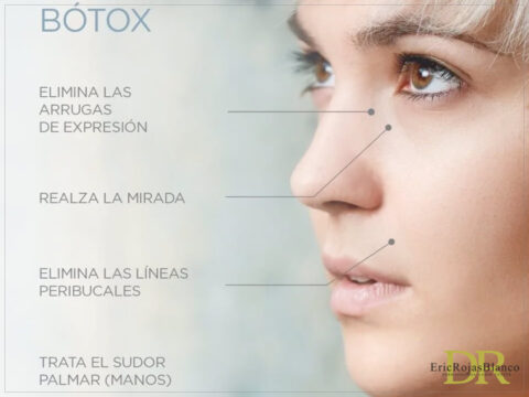 ¿EN QUÉ CONSISTE EL BÓTOX Y QUE ZONAS TRATA? - Dr. Eric Rojas ...