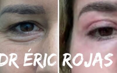 DermablefaroPlastia DR ÉRIC ROJAS REFRESCA TU ROSTRO