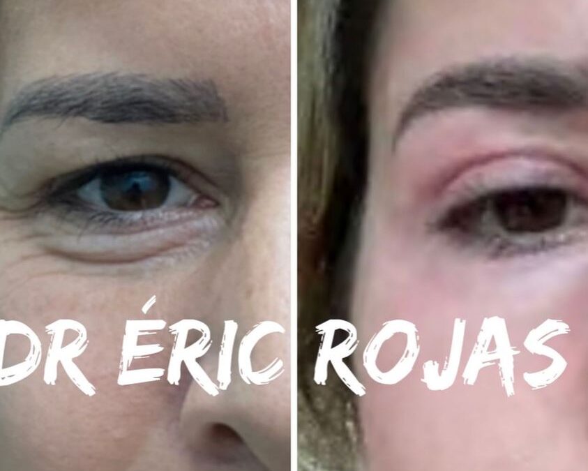 DermablefaroPlastia DR ÉRIC ROJAS REFRESCA TU ROSTRO