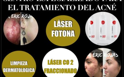 Somos el Centro Especializado para el Tratamiento del Acné Dr. Eric Rojas Blanco