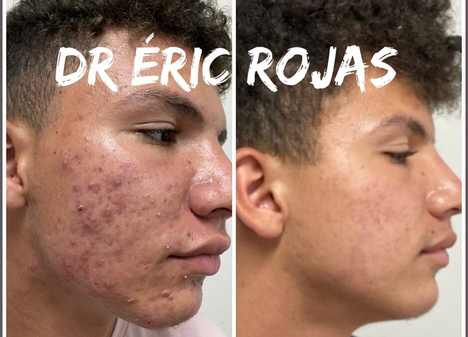 ROSTROS LIBRES DE ACNÉ