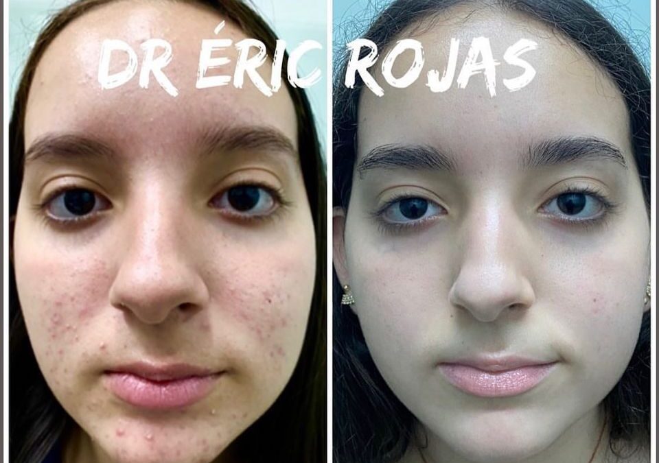 Rostros libres de acné