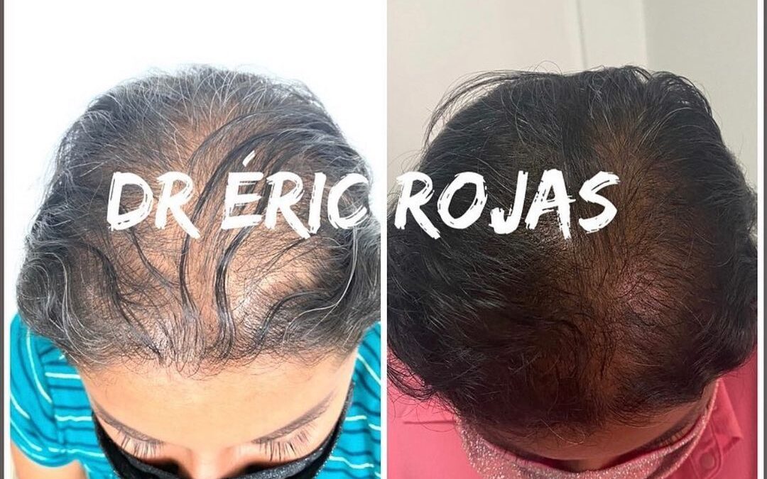 Sufres de caída del cabello?