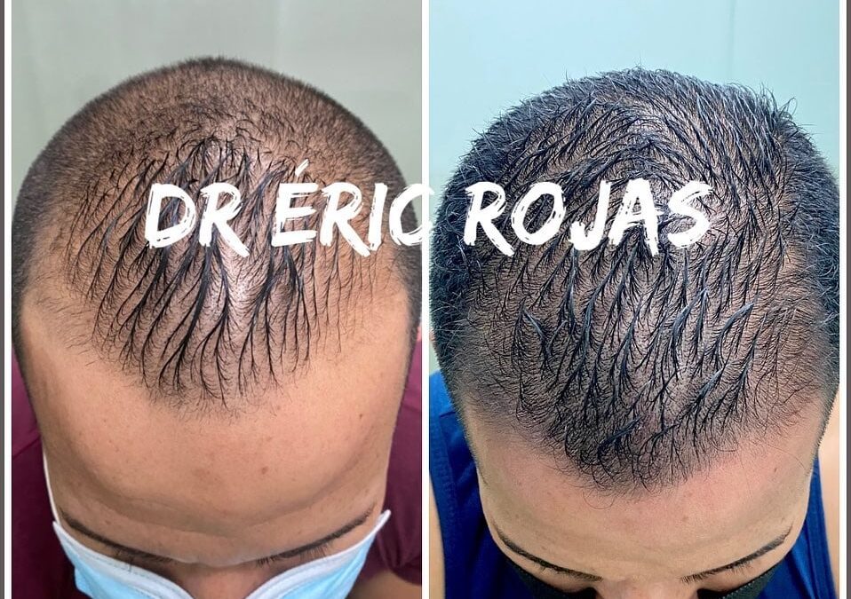 La caída del cabello es uno de los principales motivos de consulta dermatológica