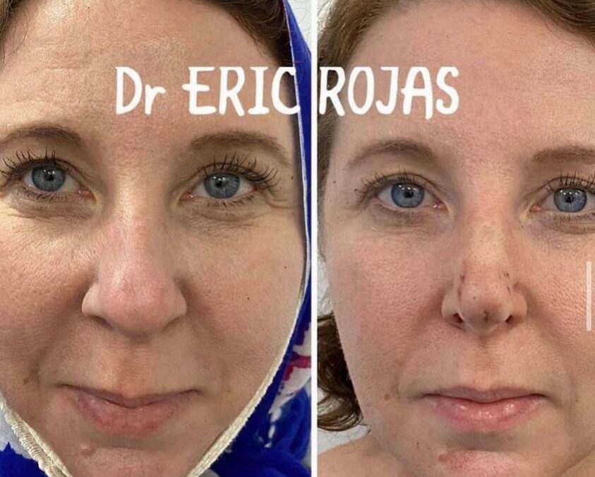 Afinamiento de punta de nariz