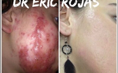 Acne severo