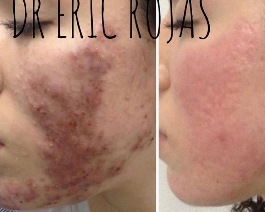 Eliminación de acné