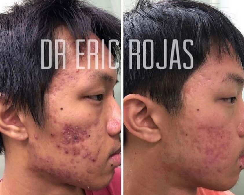 Eliminación de acné