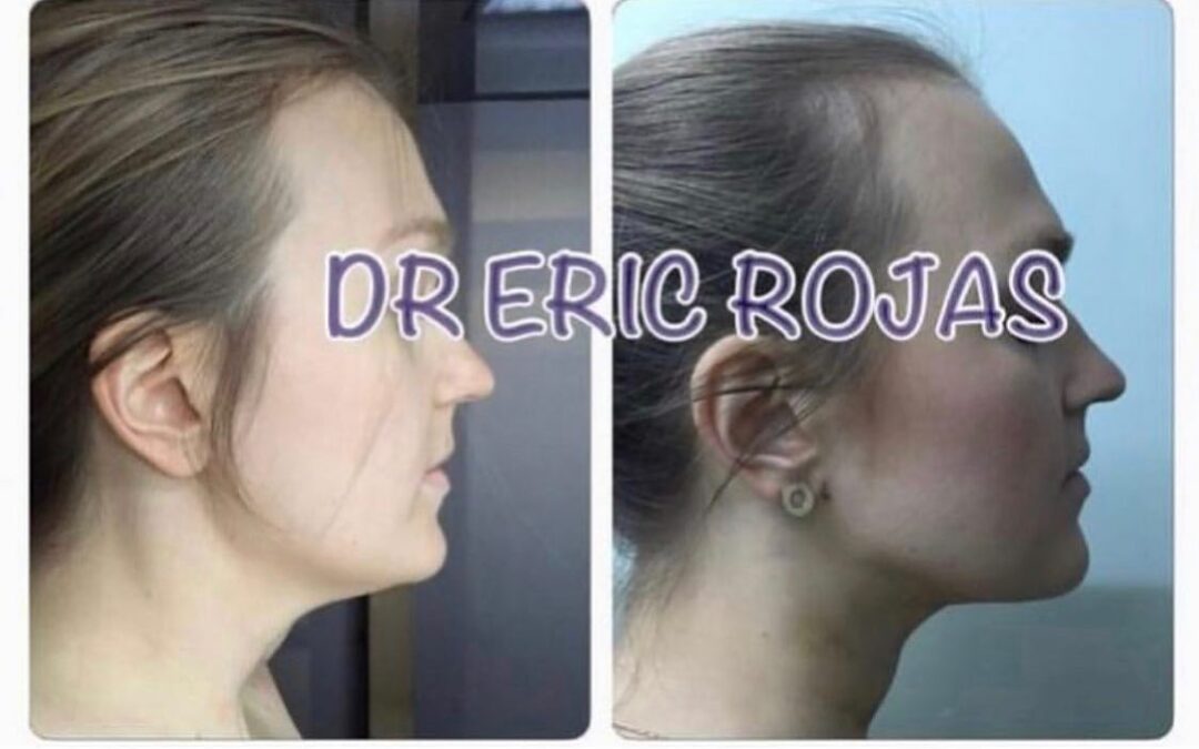 Disminución de papada