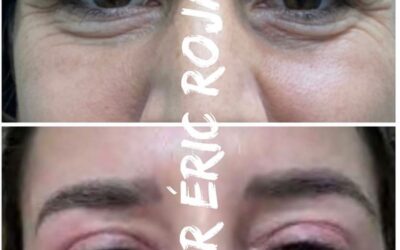 Dermablefaroplastia