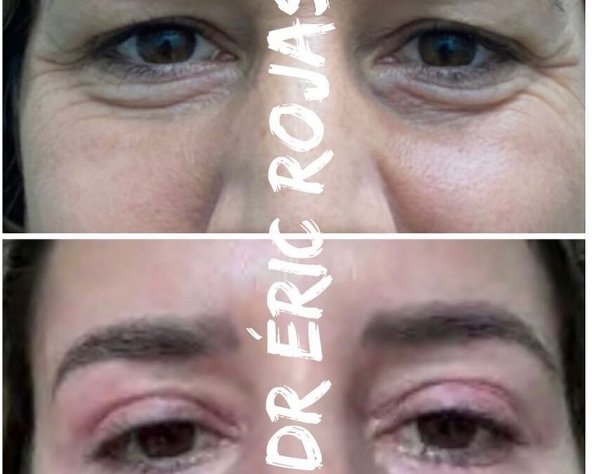 Dermablefaroplastia