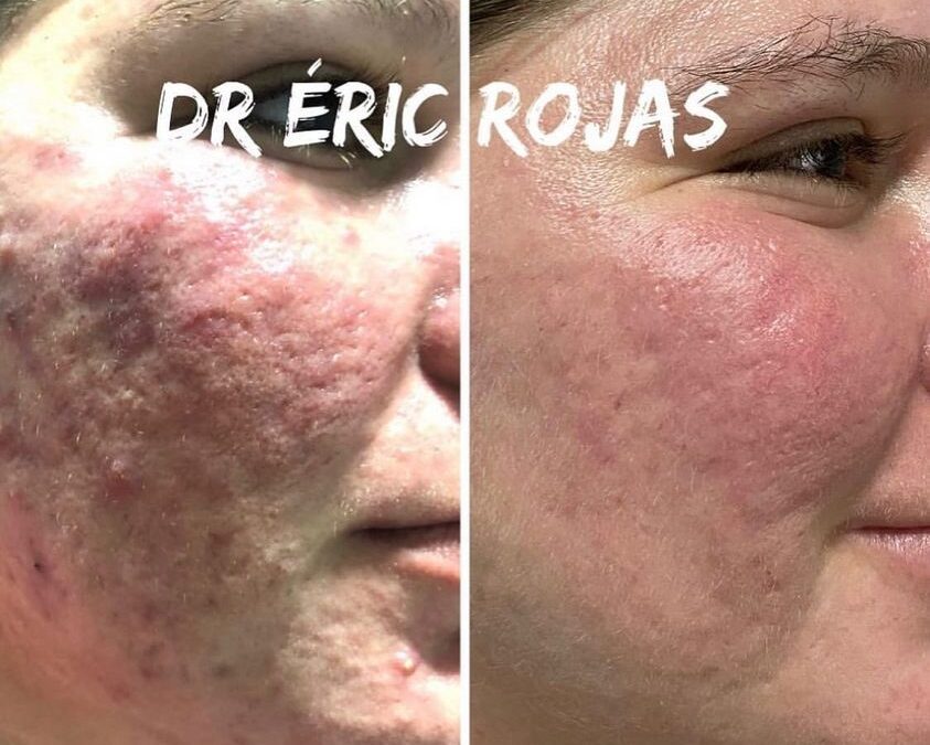 Rosacea ya no más