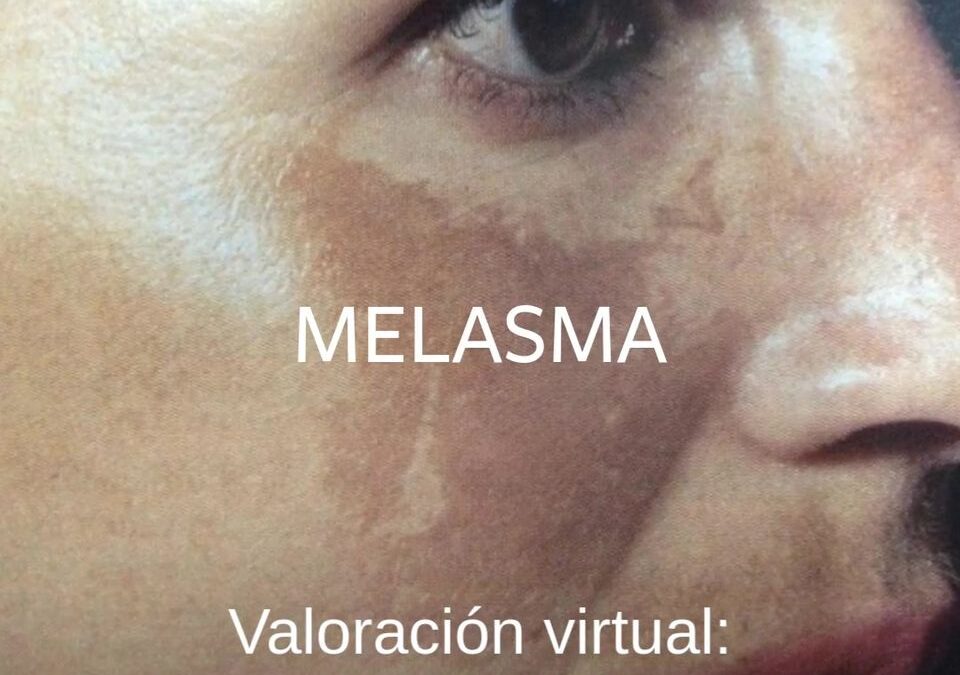 Melasma