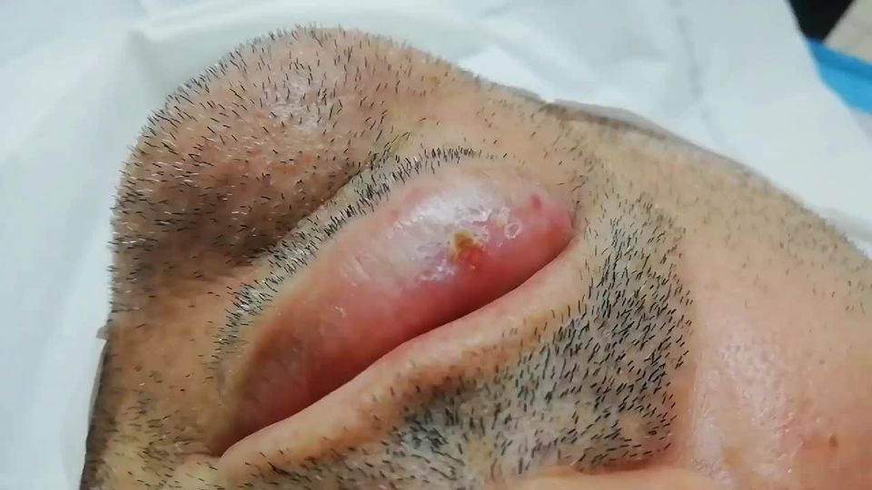 Carcinoma Epidermoide de Labio.