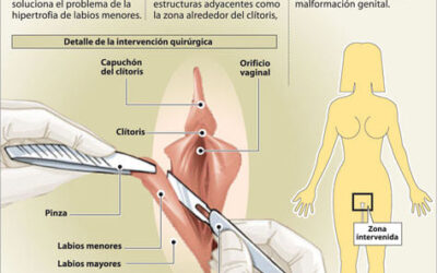 ¿Porqué una dermolabiplastía?