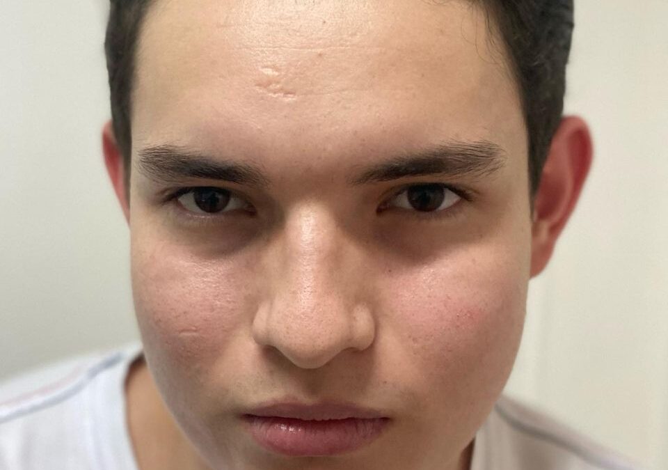 Rostros limpios de ACNÉ