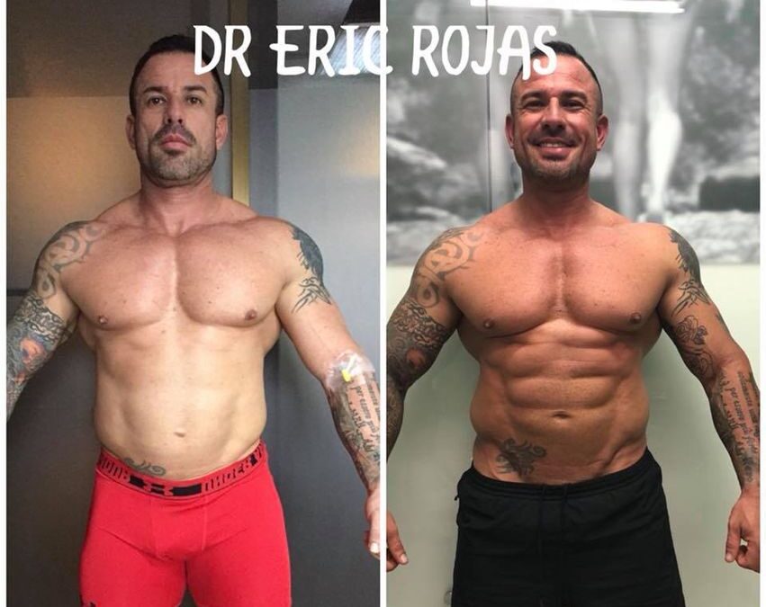 Resultados reales Slim Láser