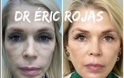 Refrescamiento FACIAL