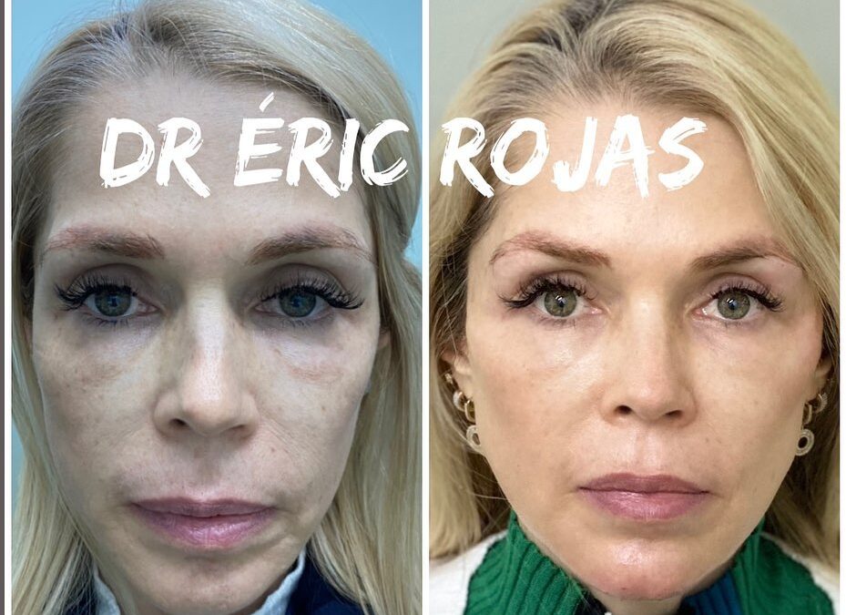 Refrescamiento FACIAL