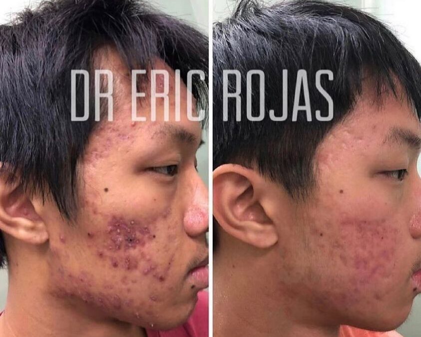 Rostros libres de acné