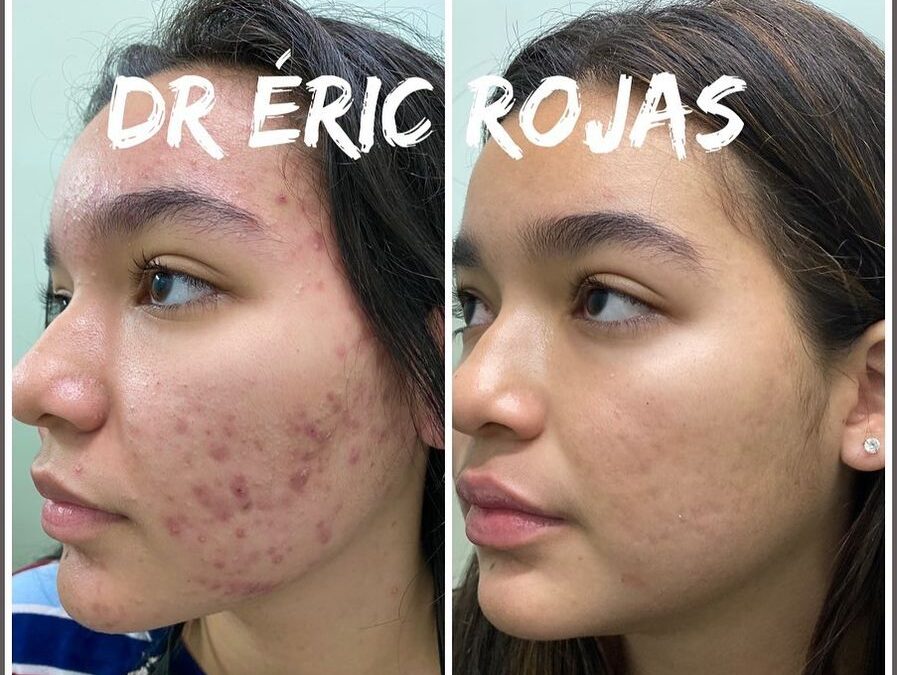 ROSTROS PERFECTOS SIN ACNÉ