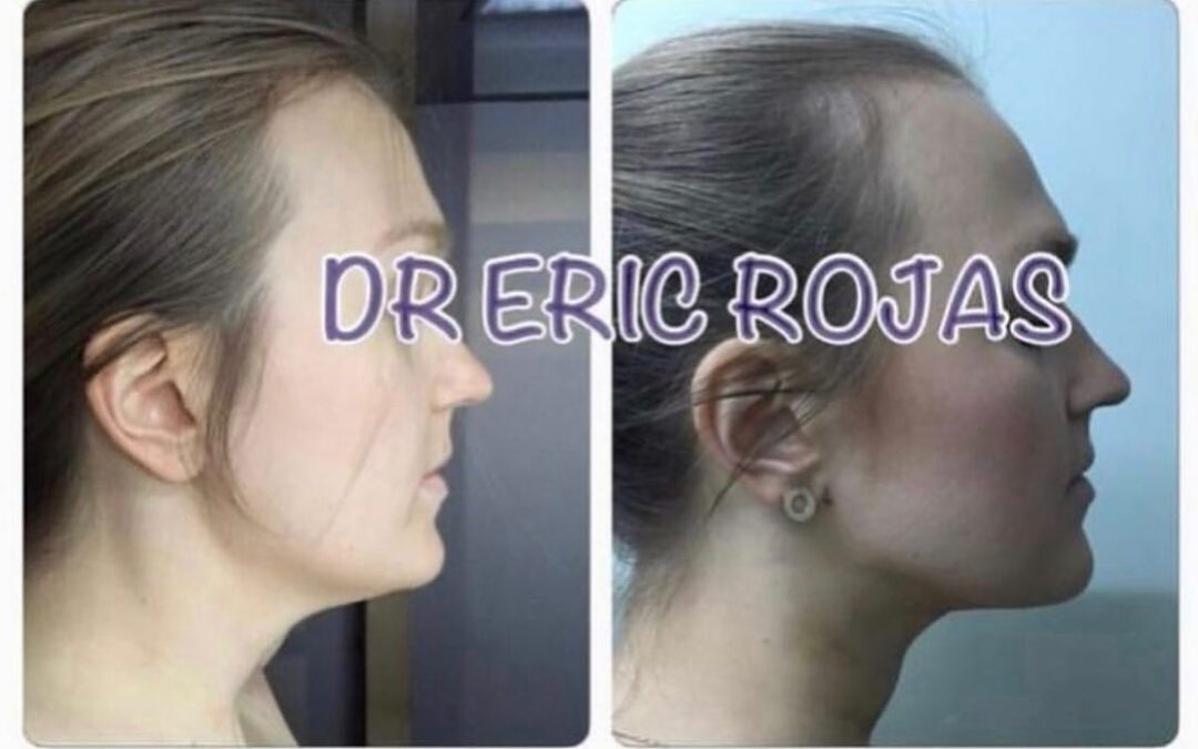 Disminución de papada