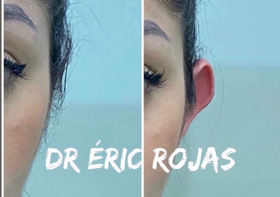 Corrección de orejas