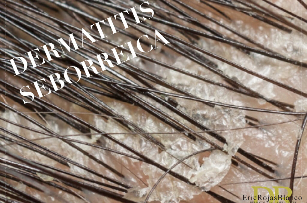 Controlamos la Dermatitis Seborreica