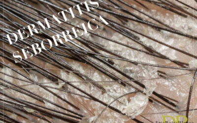 Controlamos la Dermatitis Seborreica