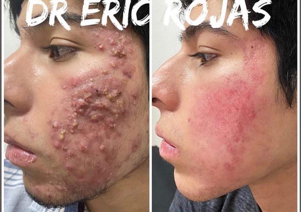 Eliminación de acné