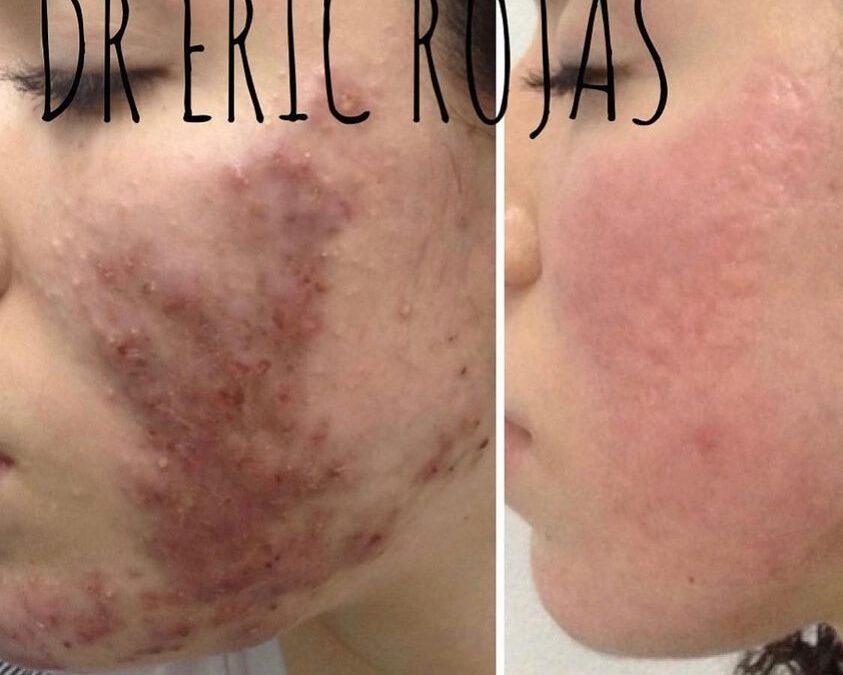 Elimina el acné con el mejor