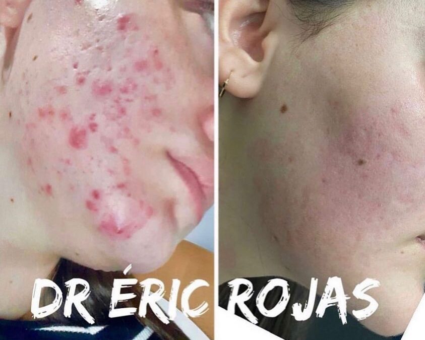 Rostros libres de acné