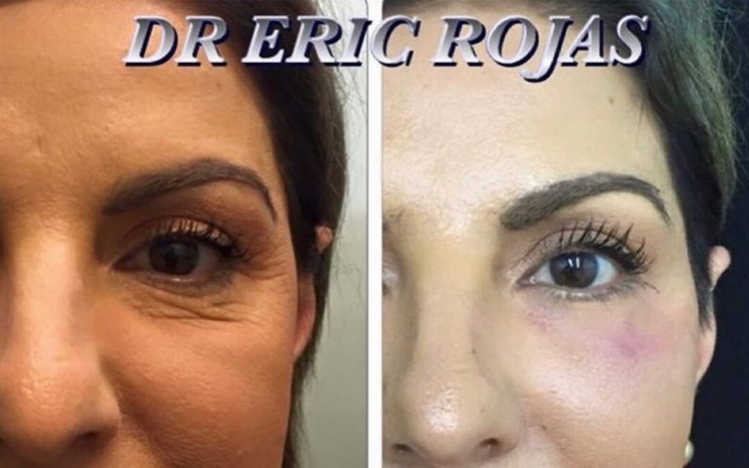 Rejuvenecimiento facial