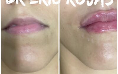 MOLDEO de LABIOS DR ÉRIC ROJAS 22483535
