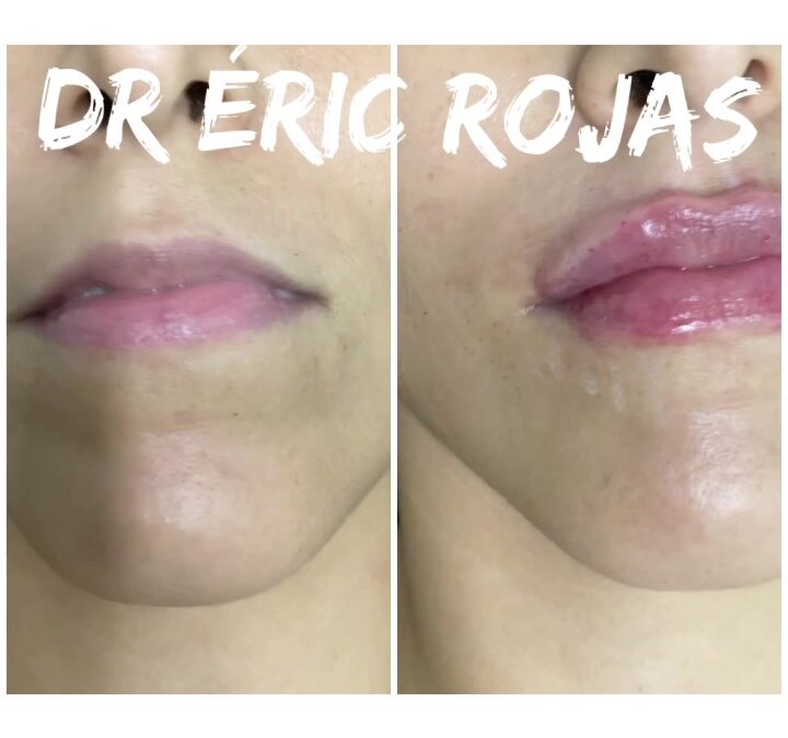 MOLDEÓ  de LABIOS DR ÉRIC ROJAS 22483535