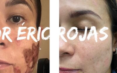 Paciente quemada con ácido en una estética