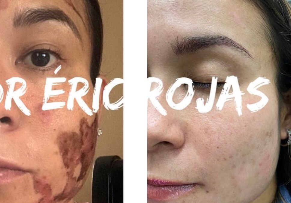 Paciente quemada con ácido en una estética