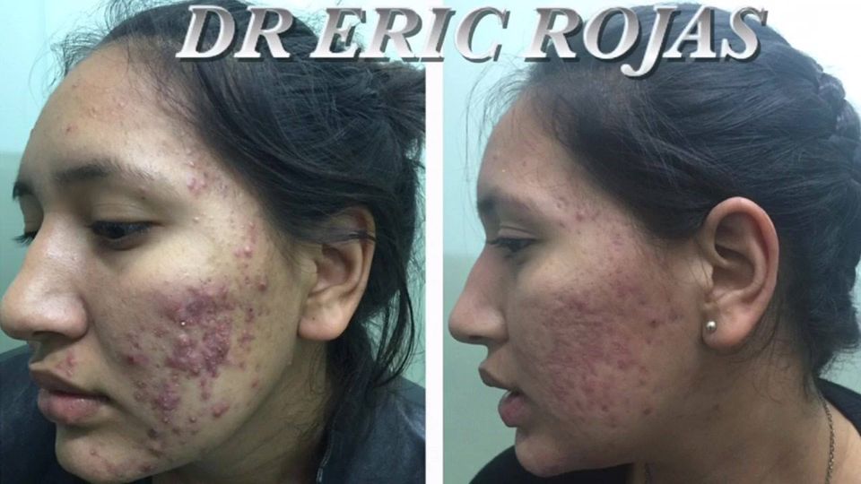 NOSOTROS TE CURAMOS EL ACNÉ SOLO BÚSCANOS CONFÍA EN MÁS 18 AÑOS DE MEJORAR ROSTROS.