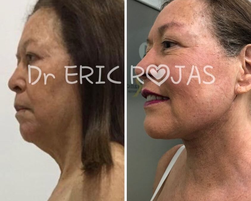 PAPADA SLIM LÁSER BUSCANOS ESTE MES EN OFERTA DR ÉRIC ROJAS 22483535