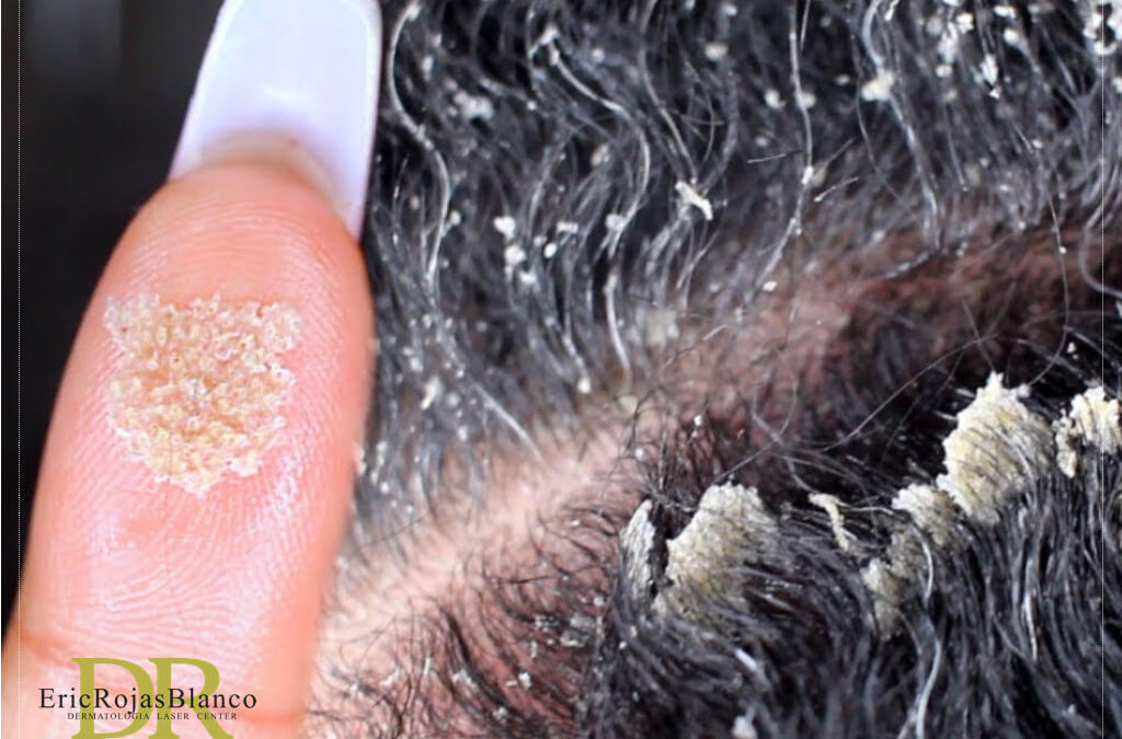 La caspa puede surgir en cualquier momento y todos los tipos de cabello y de cuero cabelludo son susceptibles