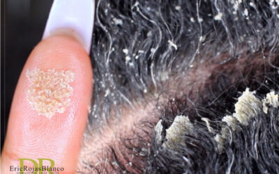 La caspa puede surgir en cualquier momento y todos los tipos de cabello y de cuero cabelludo son susceptibles