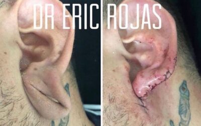 Reconstrucción de oreja